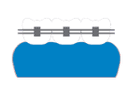 Dental Braces