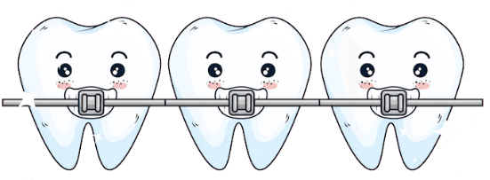 Dental Braces