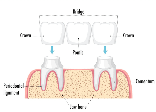 Dental Crowns and Bridges