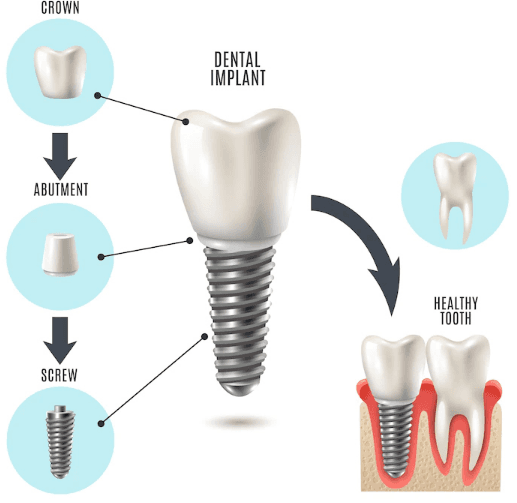 Dental Implants