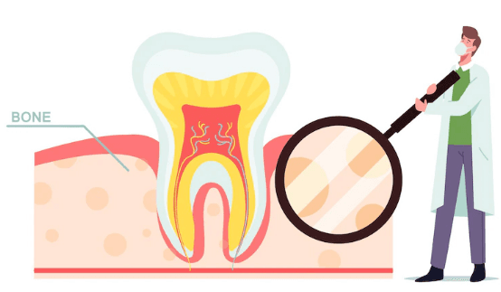 Root Canal